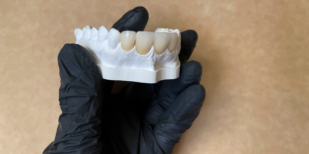 zirconia tooth cap
