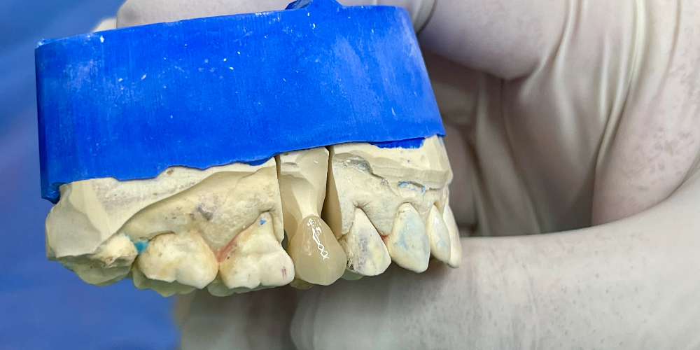 zirconia tooth crown