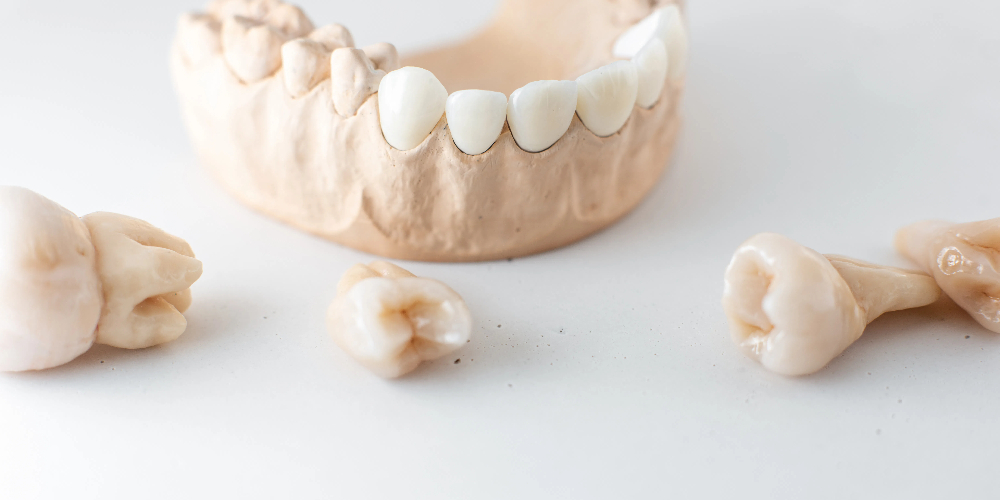 ceramic and zirconia crowns