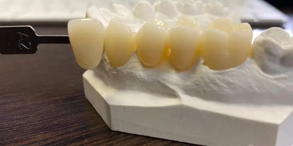 zirconia implants