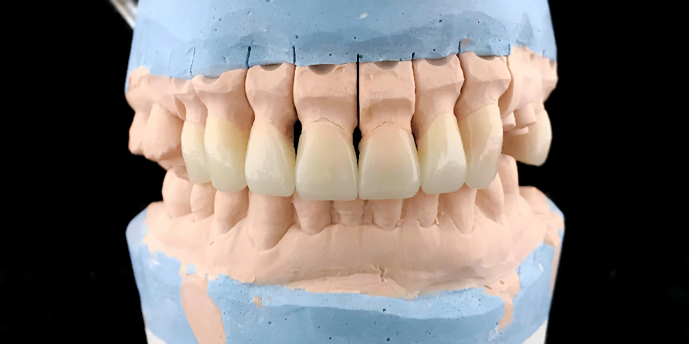 zirconia dental crown