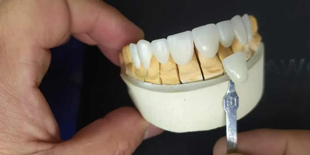 full mouth zirconia crowns