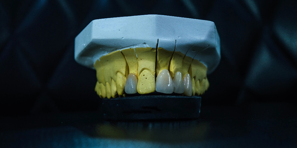monolithic zirconia bridge