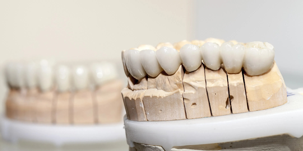 monolithic fixed teeth