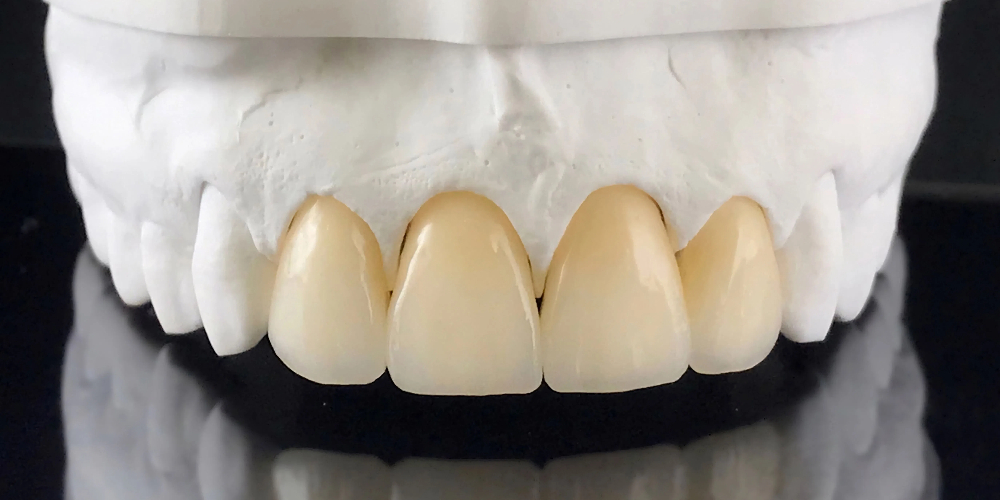 zirconia tooth cap