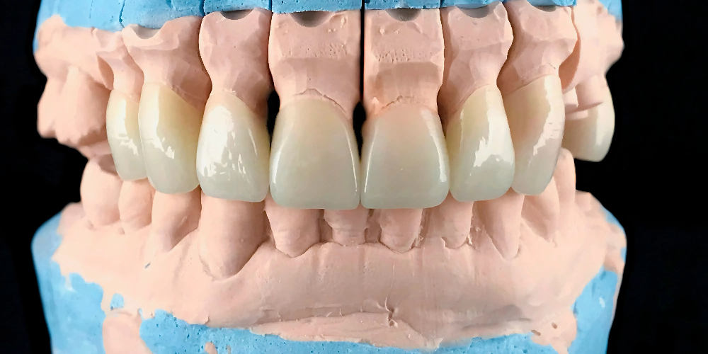 multilayer zirconia block