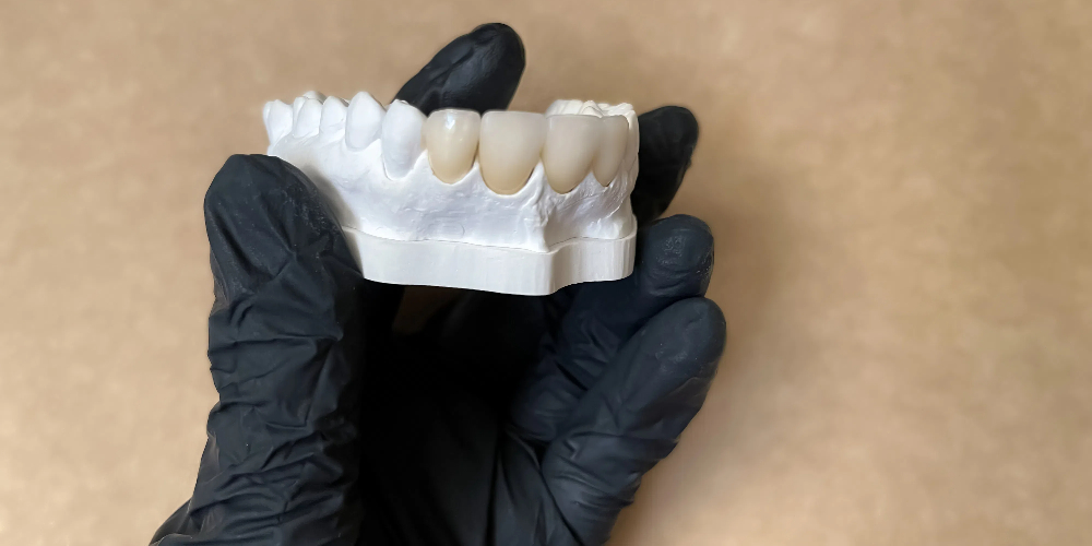 front teeth zirconia crowns