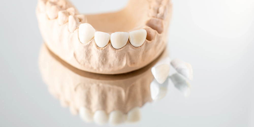 monolithic zirconia bridge