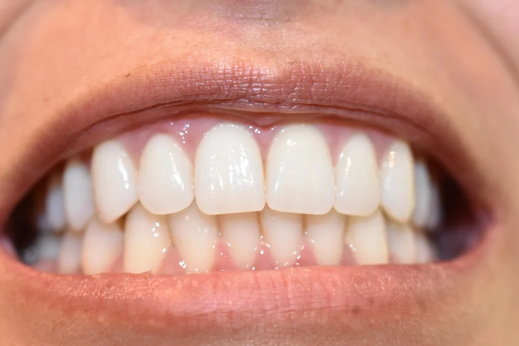 zirconia tooth cap