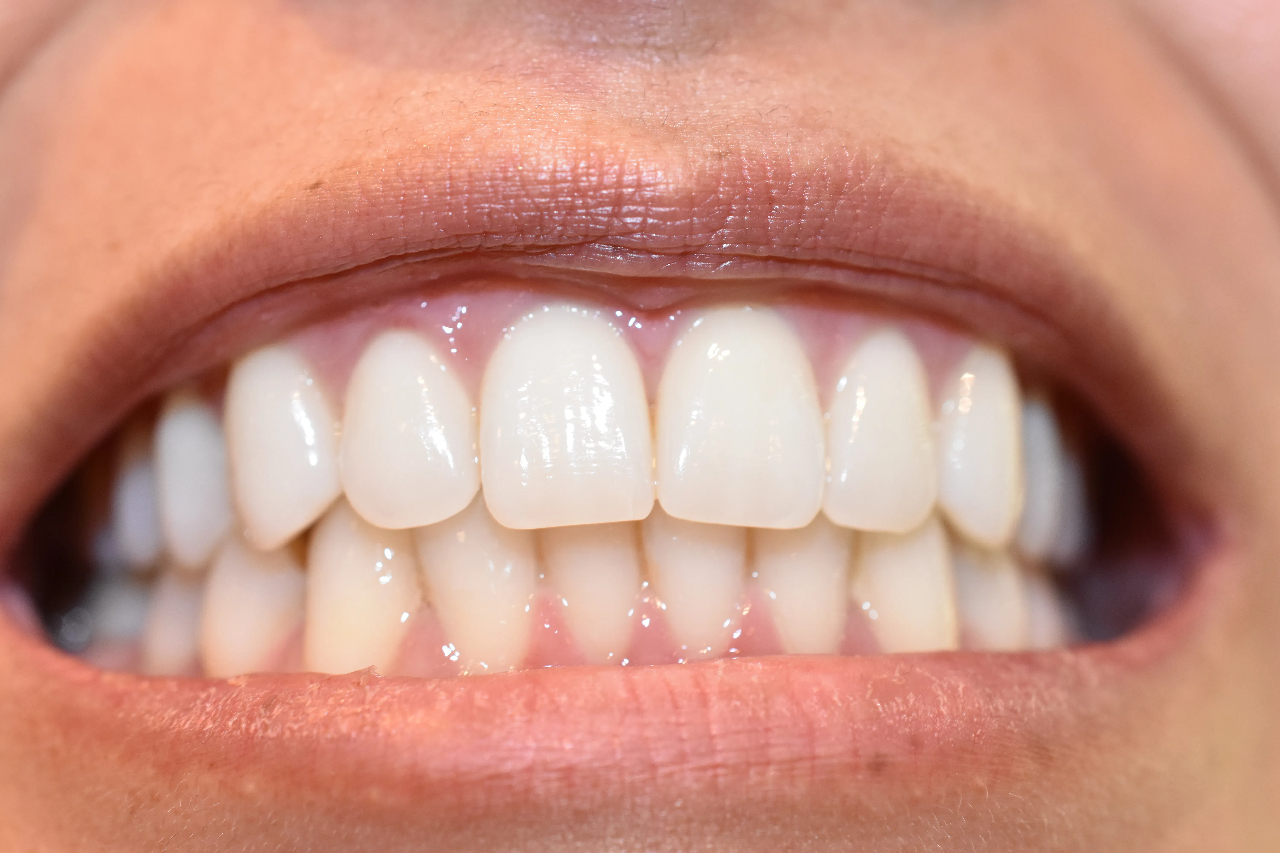 zirconia tooth cap