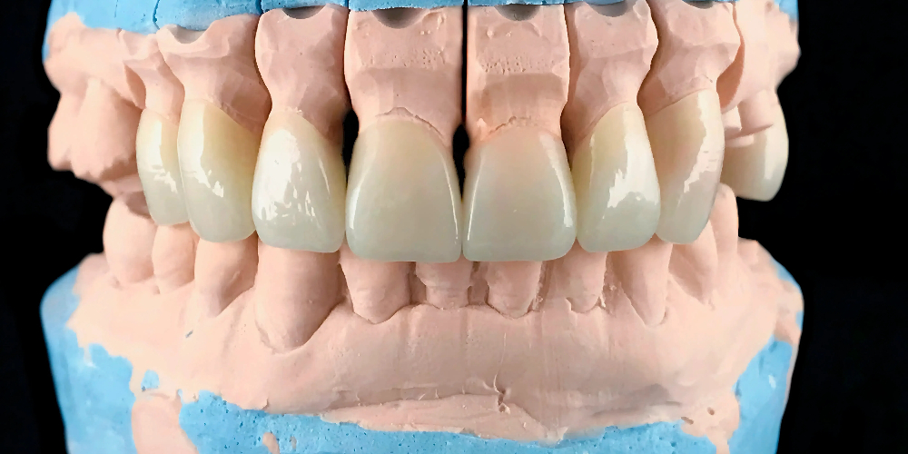 monolithic fixed teeth