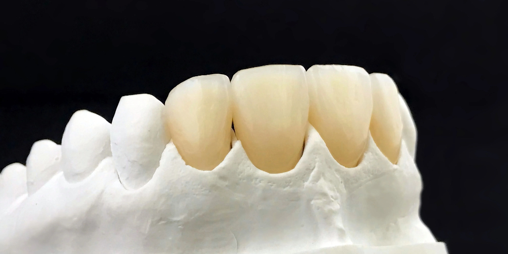 monolithic fixed teeth